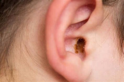 cerumen impactions in children